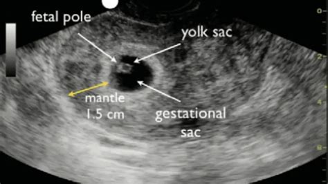 The fetal pole becomes visible somewhere between 5 1/2 and 6 1/2 weeks of gestational age (typically determined based on the date of the last . . No fetal pole at 8 weeks should i be worried